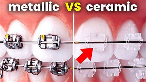 Braces Ceramic Vs Metal