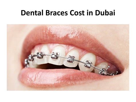 Braces Cost Dubai