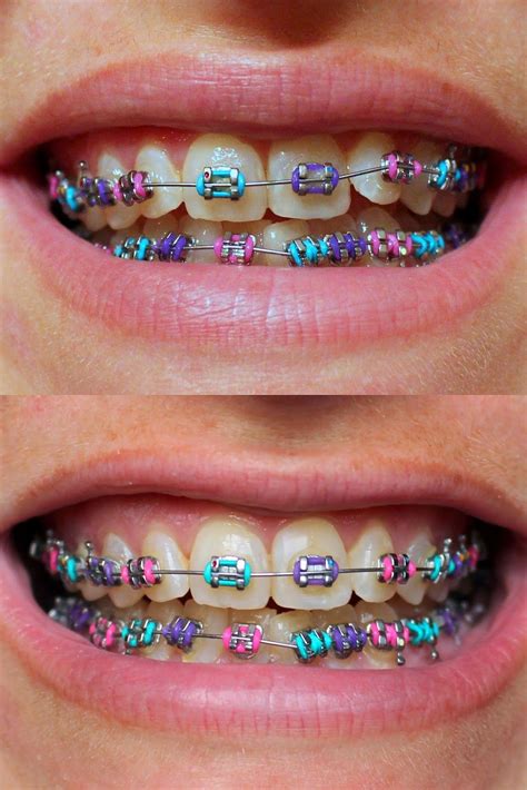 braces cute colors