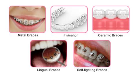 Braces Equipment