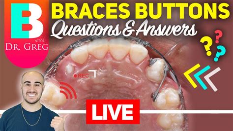 Braces Explained Youtube