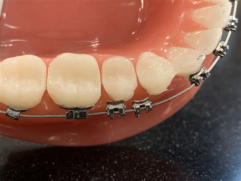 Braces For Broken Teeth