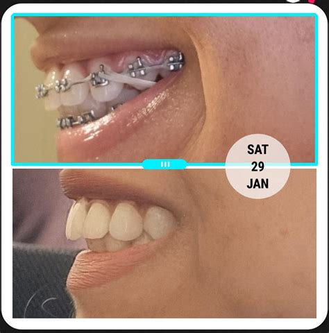 Braces For Overbite Reddit