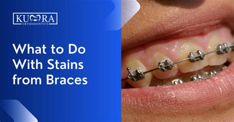 Braces For Stained Teeth