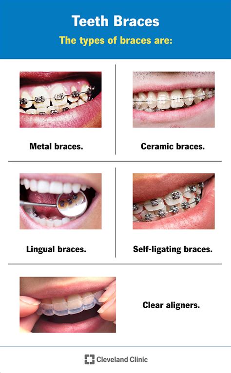 Braces For Teeth Uses