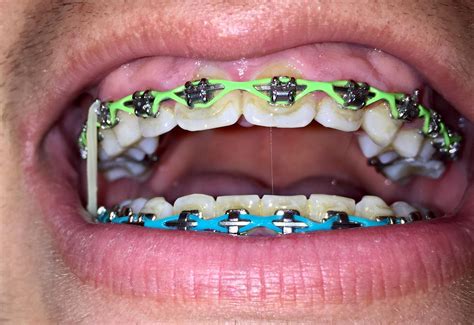 Braces Glue Spots