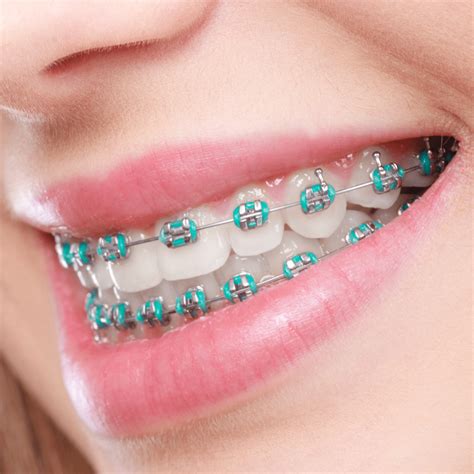 Braces In Your Teeth