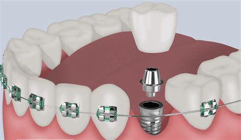 Braces On Dental Implants