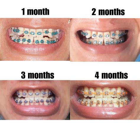 Braces Orange Bands