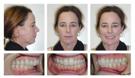 Braces Orthognathic Overbite
