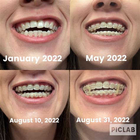 Braces Progress Pictures