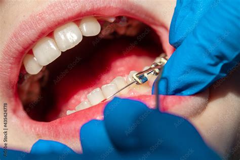 Braces Pulling Teeth Up