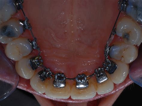 Braces Rings On Back Teeth