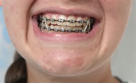 Braces Rubber Bands Chain