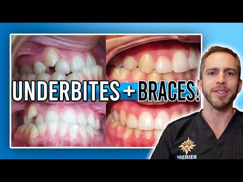 Braces Severe Underbite