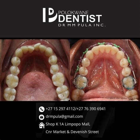 Braces Through Dentist