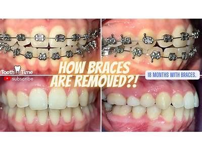 Braces Too Close To Gums