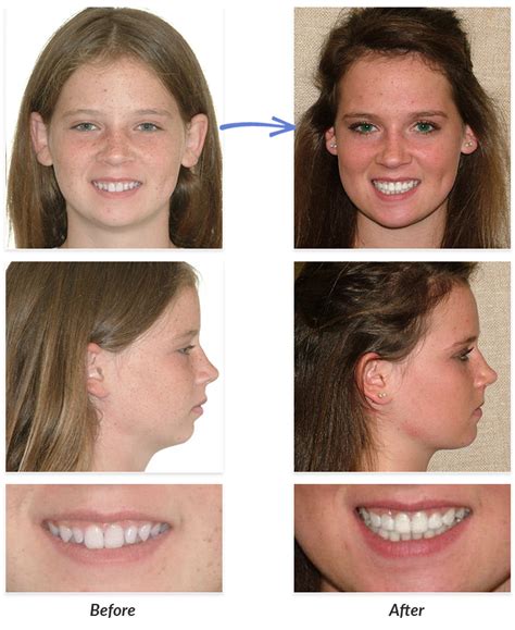 Braces Tooth Extraction Before After