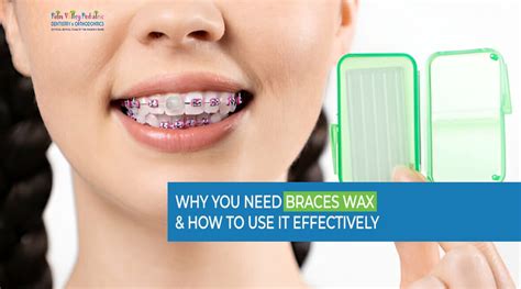 Braces Wax How Long