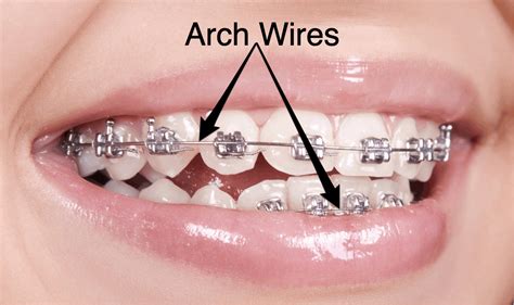 Braces Wire Archwire
