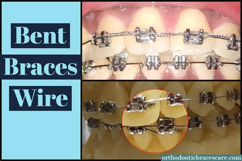 Braces Wire Bent In Front