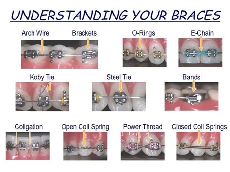 Braces Wire Levels