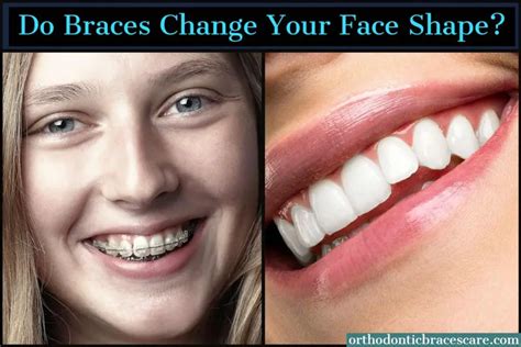 Braces With Shapes