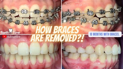 Braces With Teeth Removed