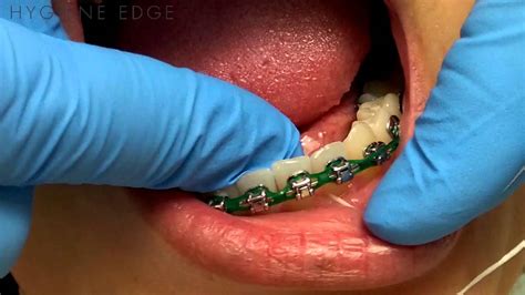 Braces Without Flossing