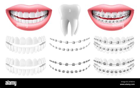 Braces Without Mouth