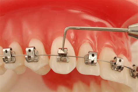 Brackets Autoligado Precio