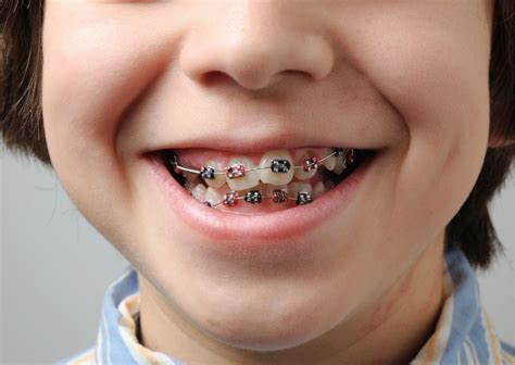 Brackets Con Dientes Chuecos