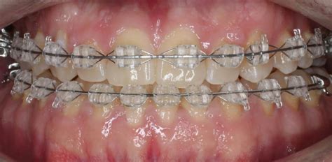 Brackets Esteticos Arco Blanco