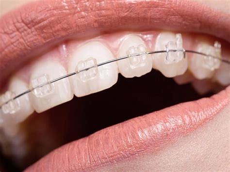 Brackets Esteticos Imagenes