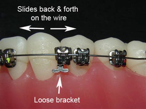 Brackets Loose On Braces