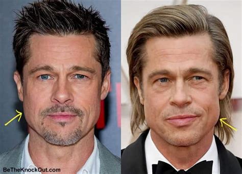 brad pitt cosmetic surgery