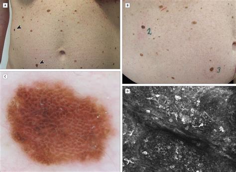 braf wild type melanoma treatment