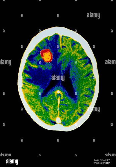 Brain Abscess Aids