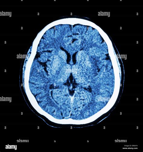 Understanding Brain CT Scan: Quick Insights and Essential Information