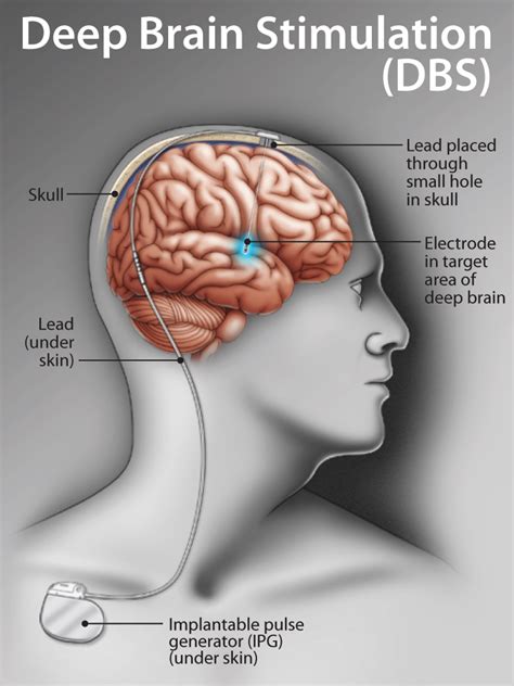 brain electrodes for parkinson's