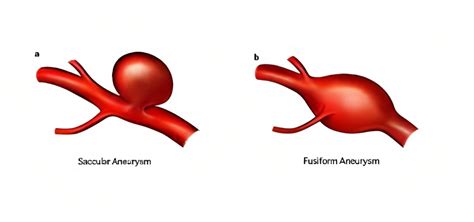 brain embolism vs aneurysm