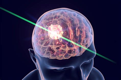 brain laser