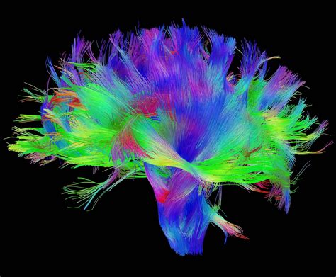 brain mri with diffusion tensor imaging