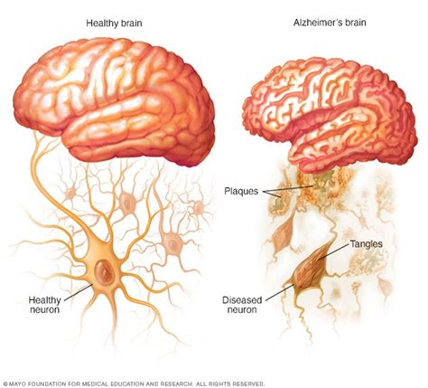 Brain Plaques Causes