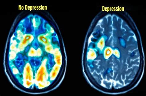 brain scanning for depression