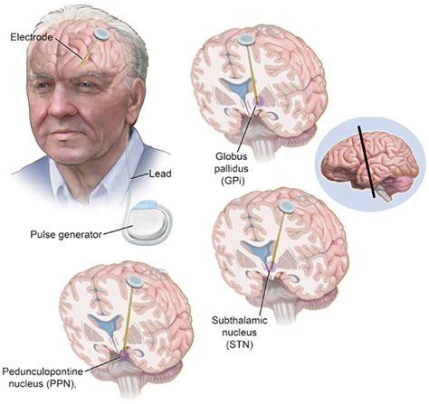 brain surgery for parkinson's disease shaking