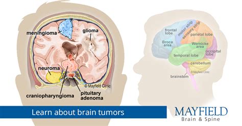 brain tumor common
