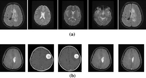 brain tumor image dataset