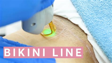 brazilian bikini laser hair removal area