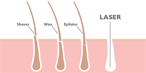 brazilian hair removal includes what